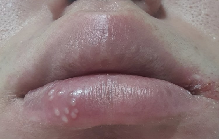 입술 포진 1형 헤르페스인가요? : 지식iN