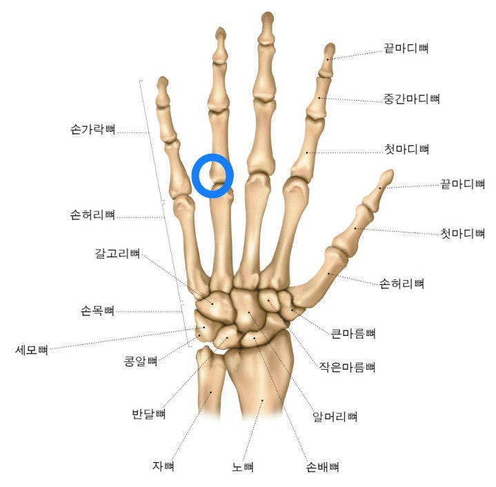 왼손 4번째 손가락 폐쇄성 근위지골 골절 : 지식iN