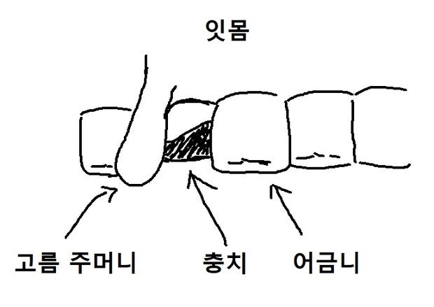 잇몸 고름 주머니 : 지식iN 잇몸 고름 주머니 : 지식In