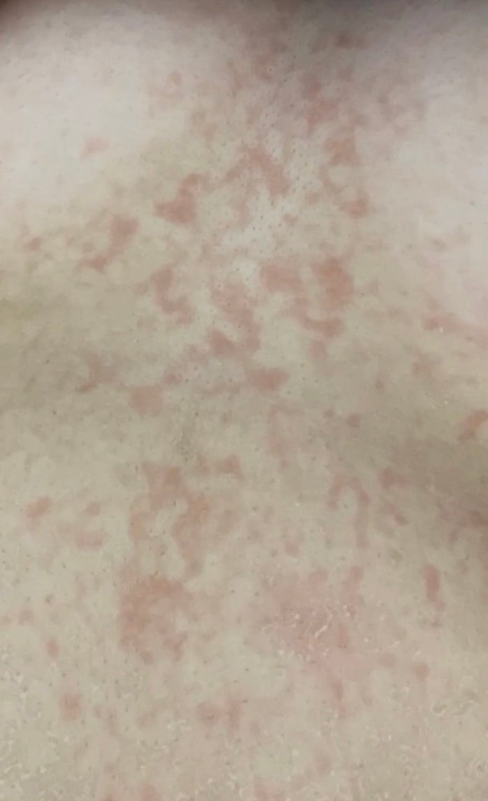 몸에 붉은 점? 반점? : 지식iN