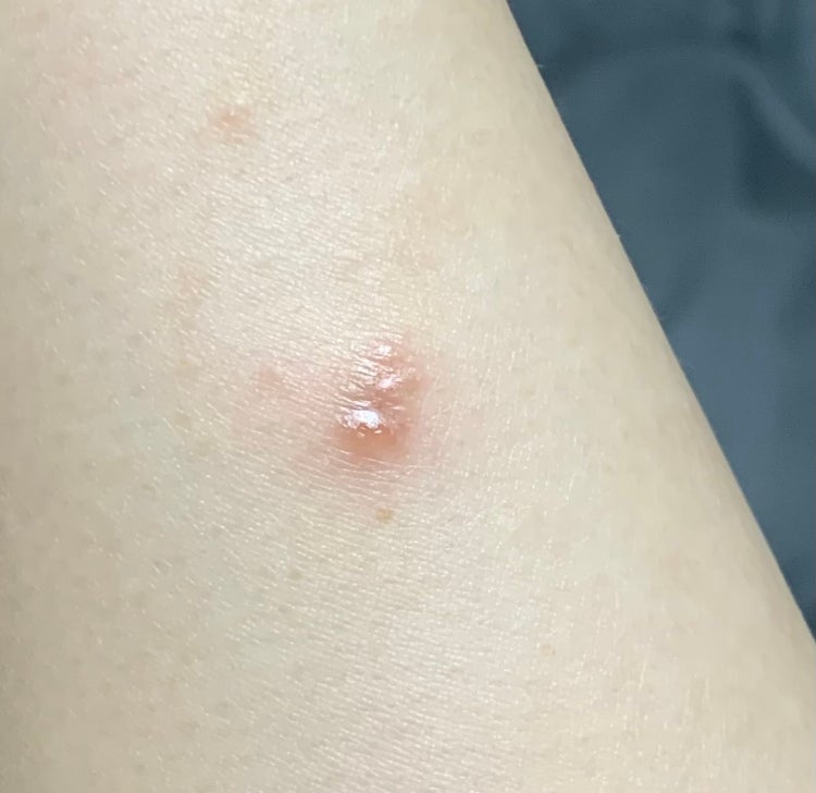 피부 수포? 이게 뭘까요? ㅠㅠ : 지식iN
