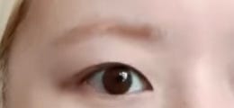 속쌍 눈매교정 : 지식iN
