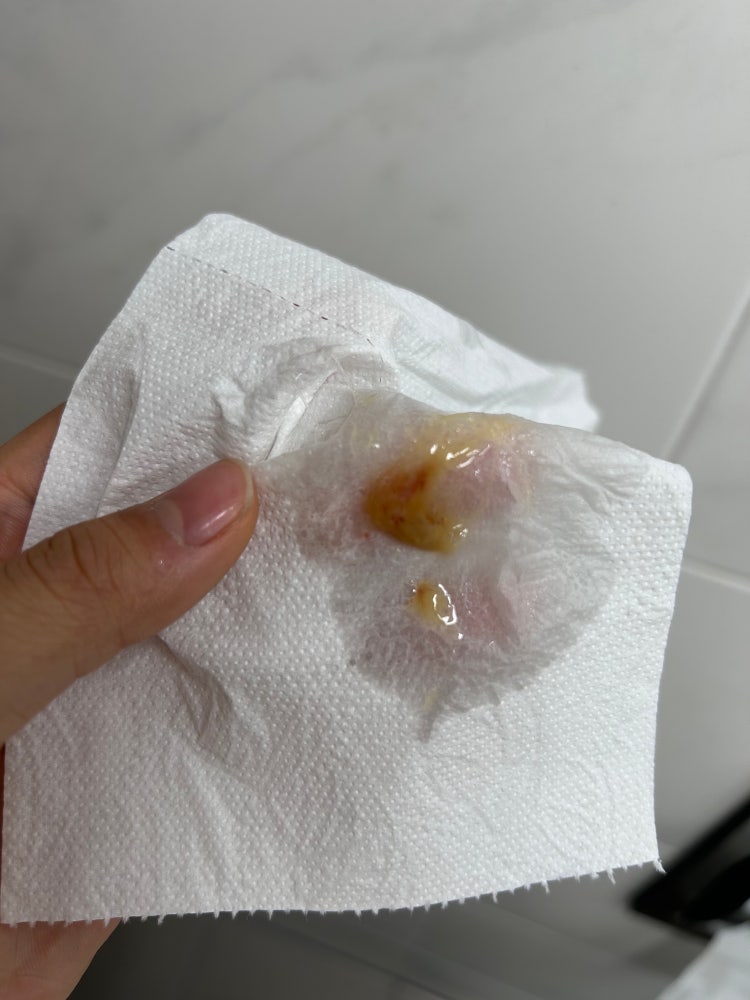 흡연자 피섞인 가래 : 지식iN