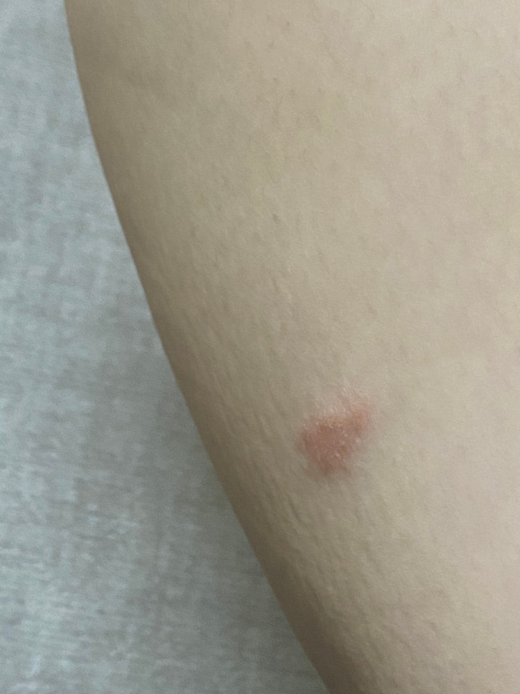 몸에 두드러기?? 습진?? 이유가 뭔가요? 사진 첨부 : 지식iN