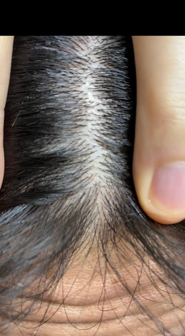 반흔성탈모 원인을찾고있습니다 두피가 얼굴피부에비해 엄청하얀데 두부 백선 인가요? (의사만) : 지식iN