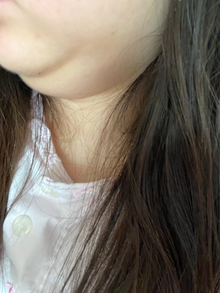 턱살? 무턱? : 지식iN