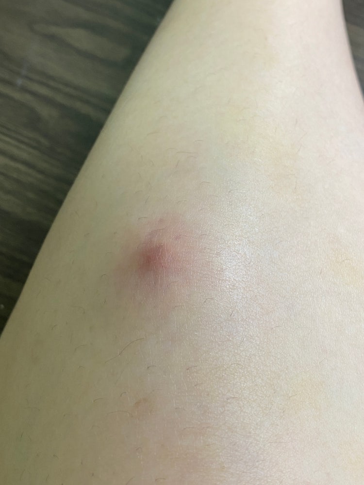 피부 종기 : 지식iN