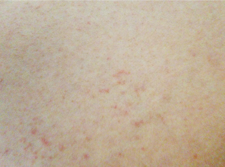 코로나 확인 후 피부발진 : 지식iN