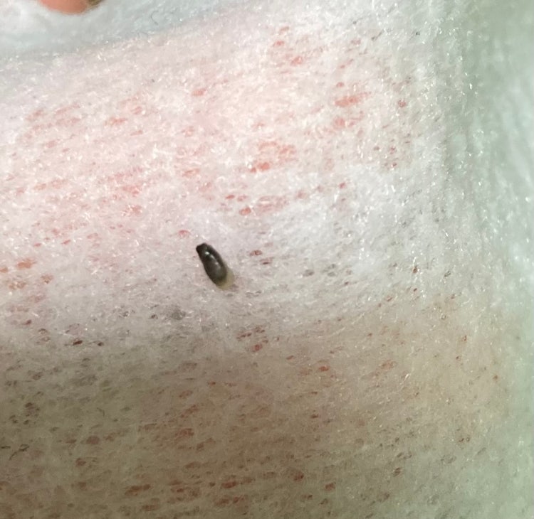 피부 검은피지 검은색 여드름 : 지식iN