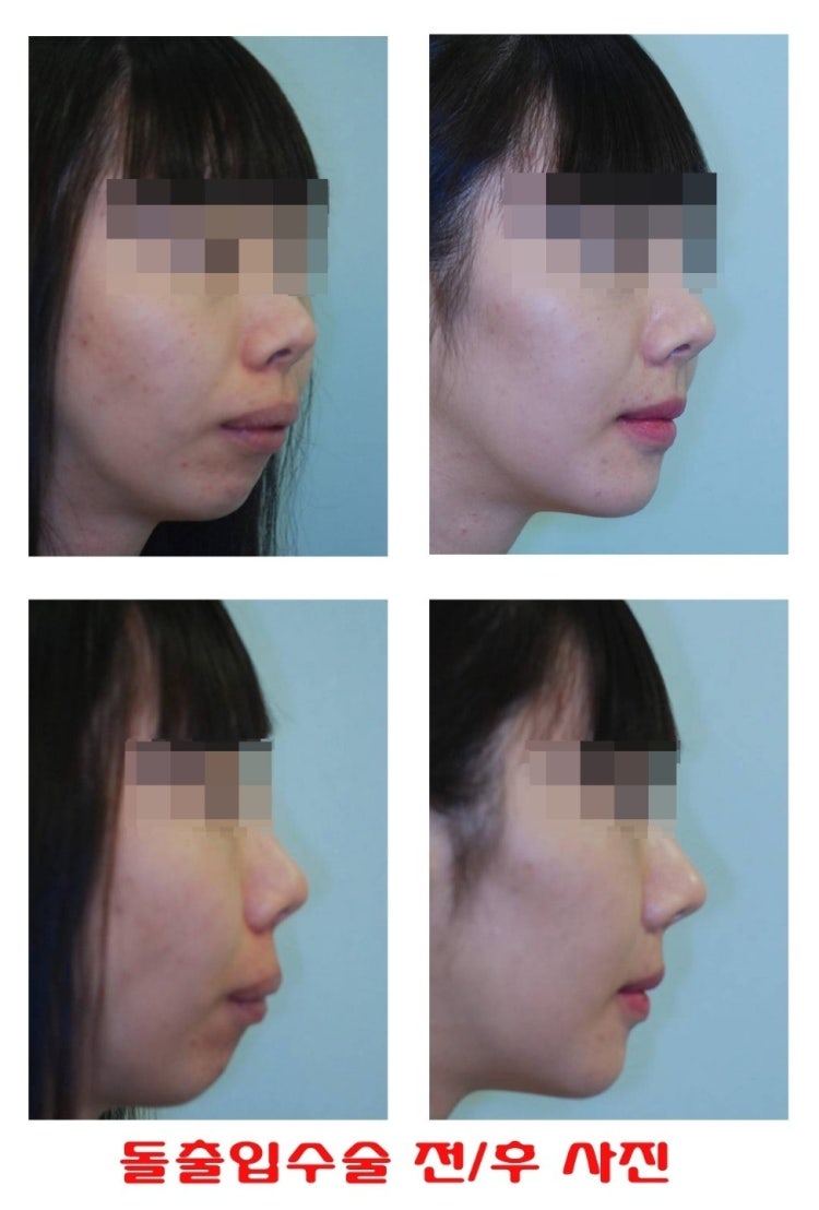 엎드려서생긴 팔자주름은 어떻게없애나요?엎드려서 팔자주름이생겼는데 피부과도가보고 성형외과도가봤는데 아직 너무어려서 레이저리프팅이나 필러는 고민을 해보라하고하던데 나중에 커서 젖살이빠지면 좀 완화될까요?그리고 코 양옆으로 파란 혈관이 팔자모양으로 뻗어 ... 엎드려서생긴 팔자주름은 어떻게없애나요?엎드려서 팔자주름이생겼는데 피부과도가보고 성형외과도가봤는데 아직 너무어려서 레이저리프팅이나 필러는 고민을 해보라하고하던데 나중에 커서 젖살이빠지면 좀 완화될까요?그리고 코 양옆으로 파란 혈관이 팔자모양으로 뻗어 ...