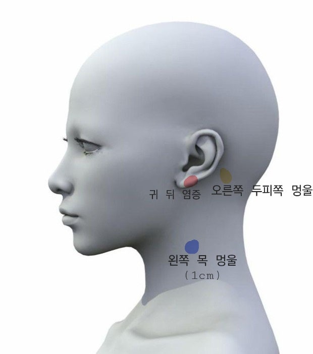 귀 뒤 목 옆 멍울(사진 첨부) : 지식iN