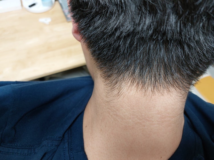 이것의 목에 있는 흑색가시세포증인데 많이 심각하나요 ????? 그리고 완벽히 없엘려면 체중을 줄이는것이 우선인가요 ...