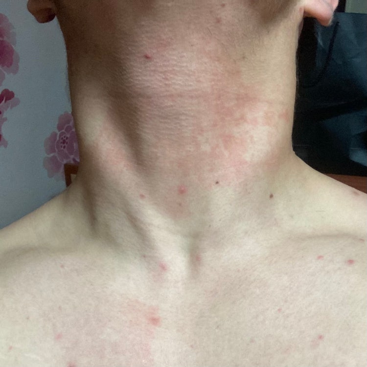 목 피부 빨간반점 목 간지러움 : 지식iN 목 피부 빨간반점 목 간지러움 : 지식In