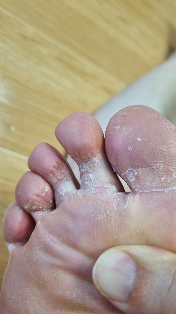 발 무좀(혐오사진 있어요ㅠㅠ) : 지식iN