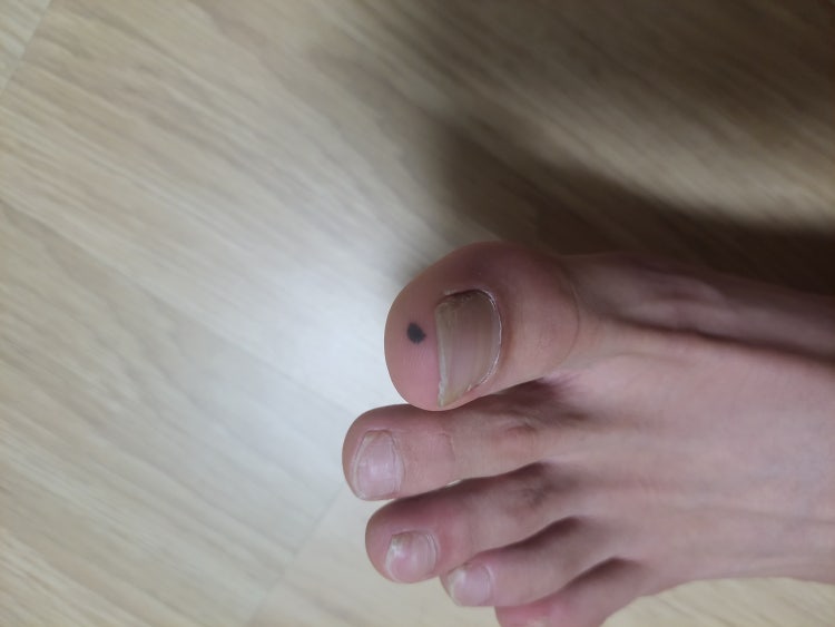 피부에 검은색 점 : 지식iN