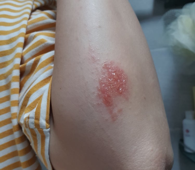 피부 습진 : 지식iN