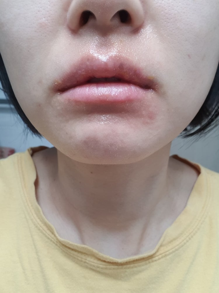 입술 주변 전체적으로 수포 올라오고..점점 번집니다. : 지식iN