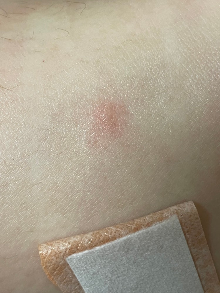 화상물집연고?? : 지식iN