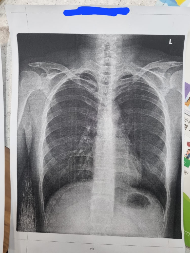 폐 물혹? xray사진 좀 봐주세요 : 지식iN