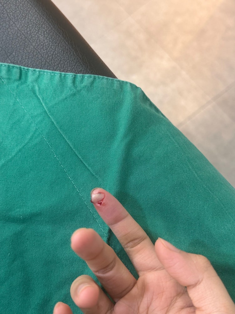 손가락 봉합 : 지식In