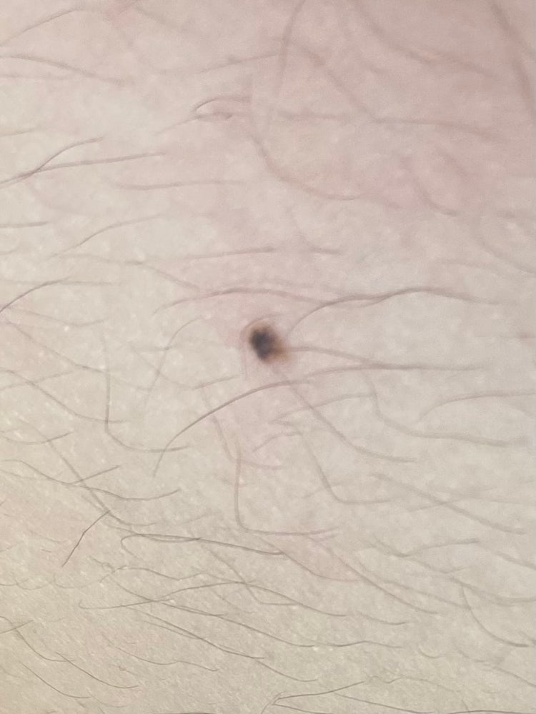 혹시 이 점 흑색종일수도 있나요?? : 지식iN