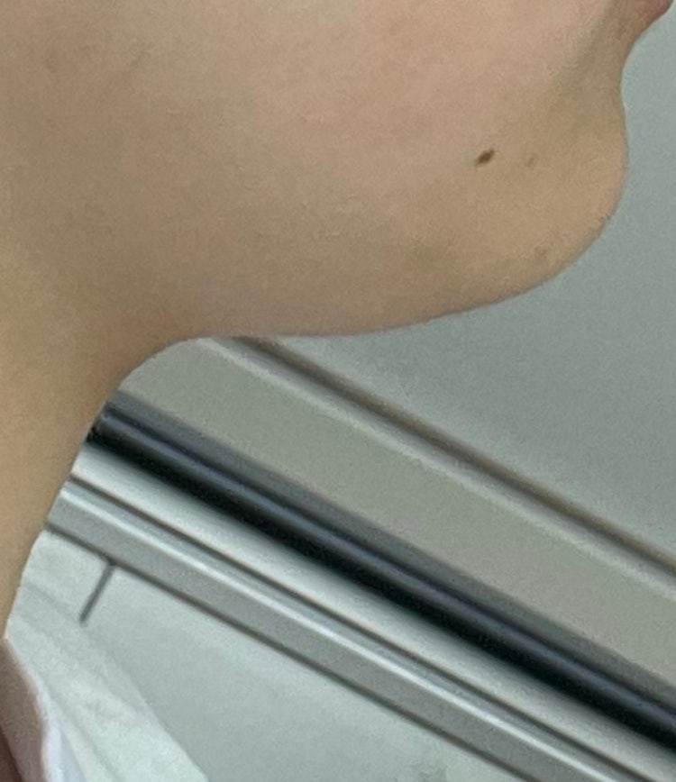 턱살 빼는법 : 지식iN