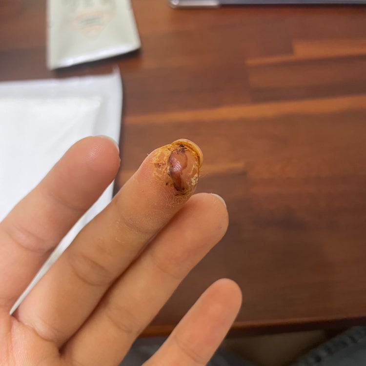 손가락 봉합수술 후 실밥 제거한지 이틀째입니다 경과 좀 봐주세요 선생님 ~~! : 지식In