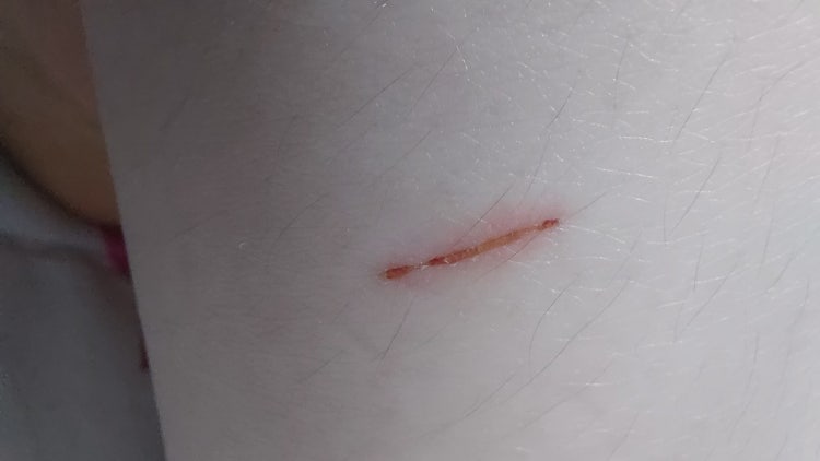 다리에 상처 난 후에 생긴 두통 파상풍 전조증상 일까요 : 지식iN