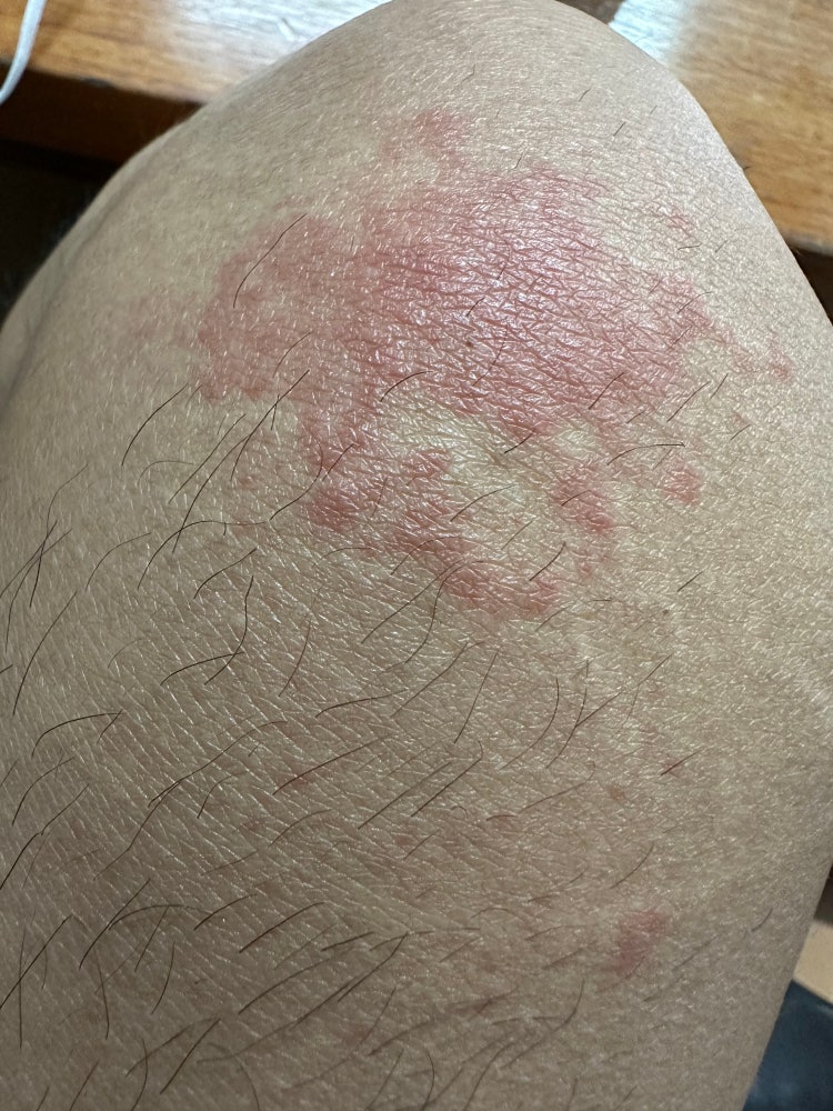 허벅지 붉은 습진 반점 : 지식iN