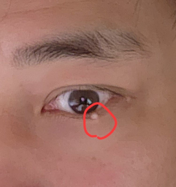 눈 비립종 안과, 피부과중 어디로 가야하나요? : 지식iN 눈 비립종 안과, 피부과중 어디로 가야하나요? : 지식In