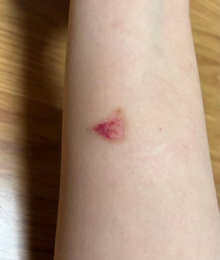 화상 흉터 피 고임 : 지식iN 화상 흉터 피 고임 : 지식In