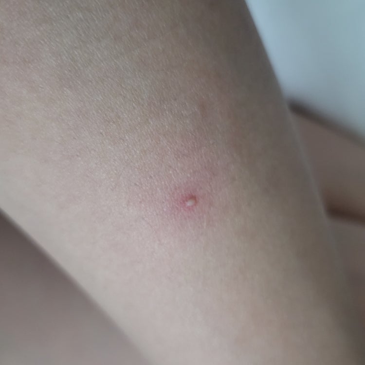 피부 수포 : 지식iN