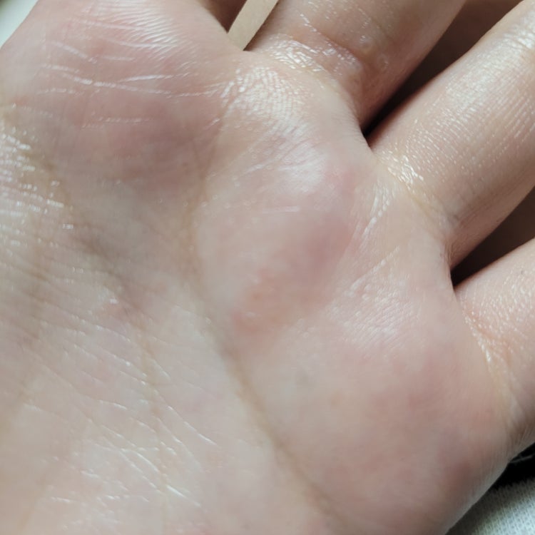 손에 좁쌀 물집 한포진 자연치료 : 지식iN