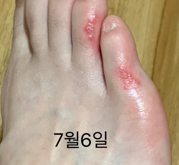 발가락 한포진 습진 물집 : 지식iN