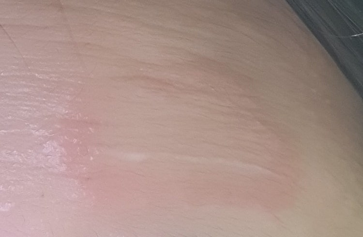 이마에 동그란 상처 백선인지 봐주세요 : 지식iN