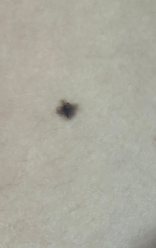이거 흑색종일 가능성 있나요?? : 지식iN