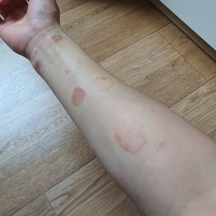 화폐상 습진일까요? 습진 종류.. : 지식iN