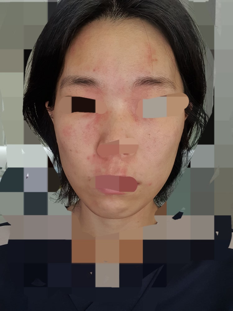 피부염. 급성 알러지? : 지식iN