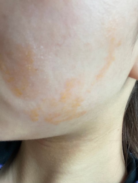 피부 진물 왜이런거고 어떻게 해야하나요? 사진은 아침에 세수하고 나와서 후시딘 바른 사진이구요. 요즘에 안 그러다가 갑자기 ...