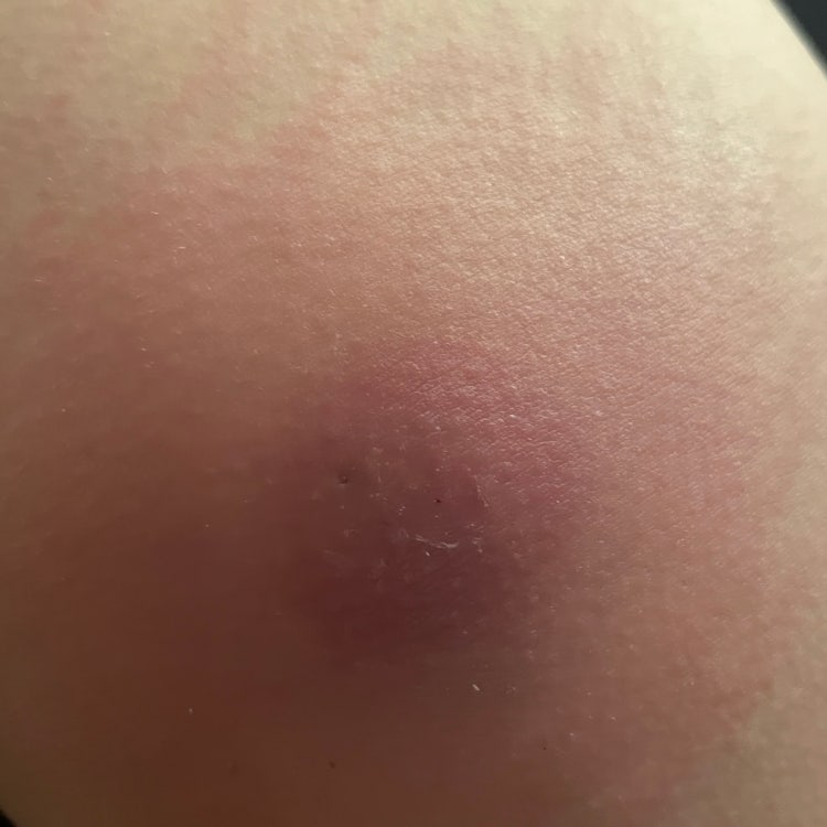 엉덩이 종기 질문이요 ㅠ : 지식iN