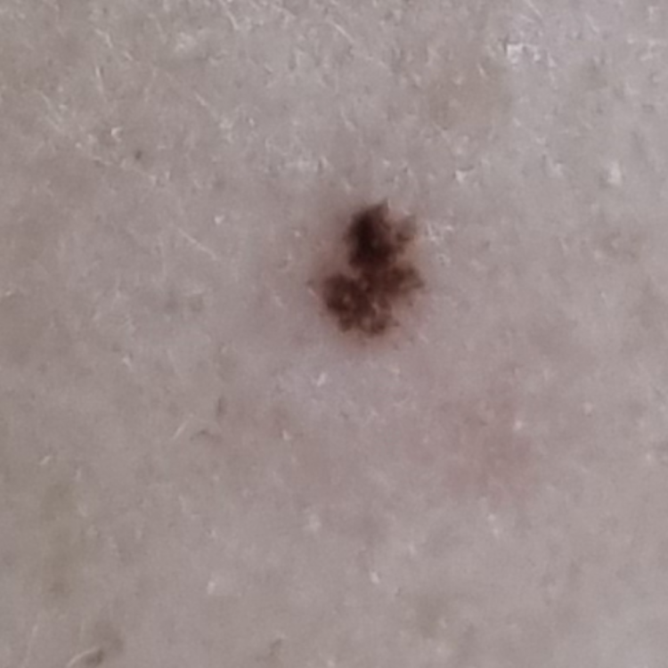 얼굴 갑자기 검은 까만 점 : 지식iN