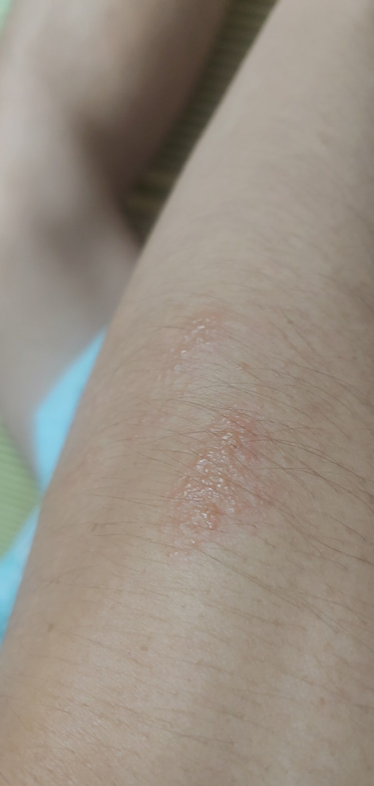 피부 수포 먼가요? 가려움 : 지식iN