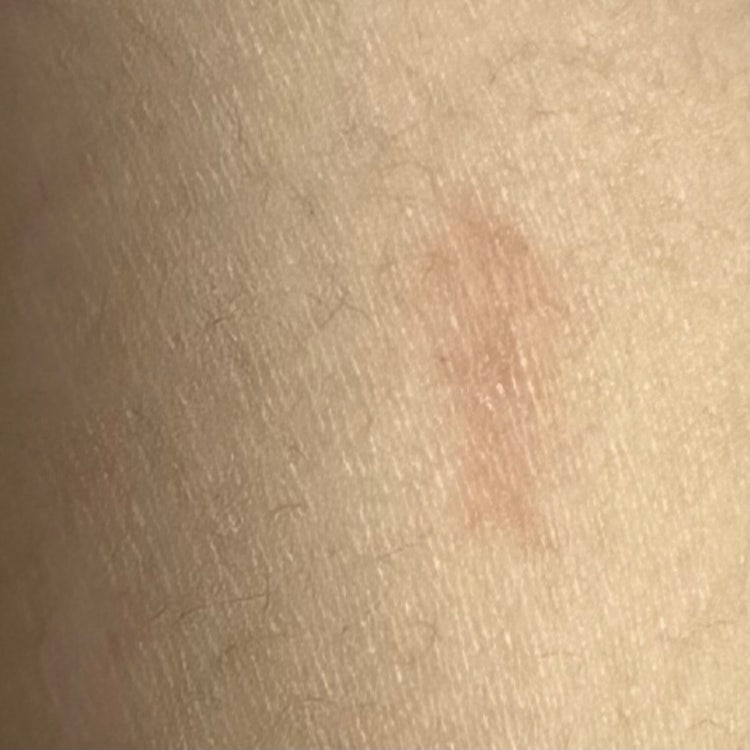 배에 길쭉한 습진..?두드러기가 났습 : 지식iN