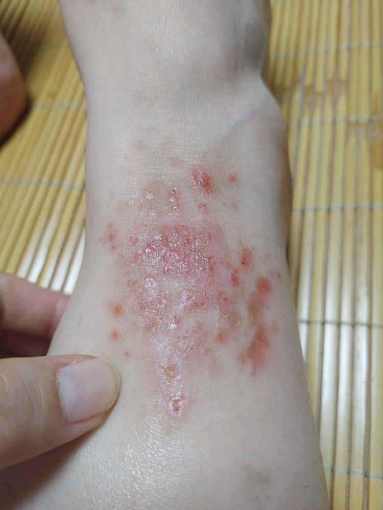 피부 상처 치료로 피부과나 외과 추천 부탁드려요 : 지식iN