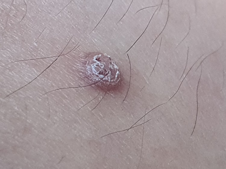 다리 피부 작은 종기? : 지식iN