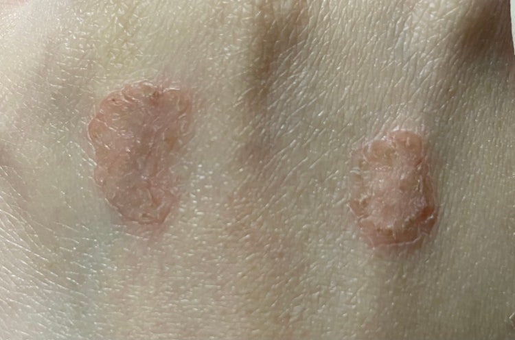 피부병 백선? 사마귀? 어떻게 치료하나요 : 지식iN