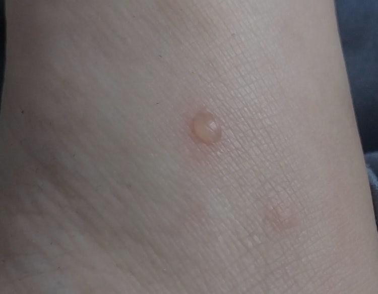 모기 물집 : 지식iN