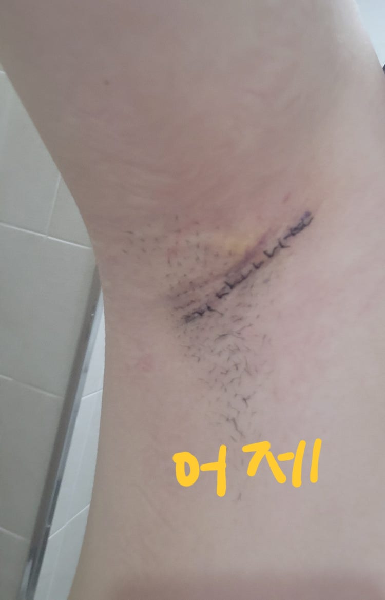 표피낭종 제거 수술 후 통증 및 붓기 : 지식iN 표피낭종 제거 수술 후 통증 및 붓기 : 지식In