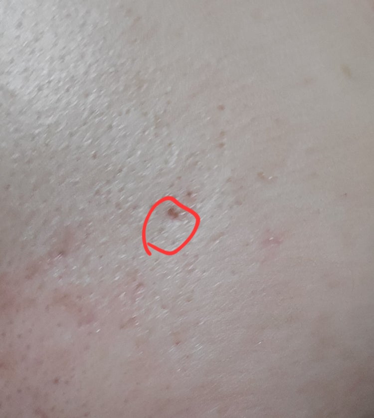 볼에 피지구멍? : 지식iN