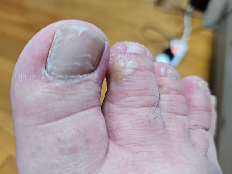 발가락 사이 흰색 물집 : 지식iN